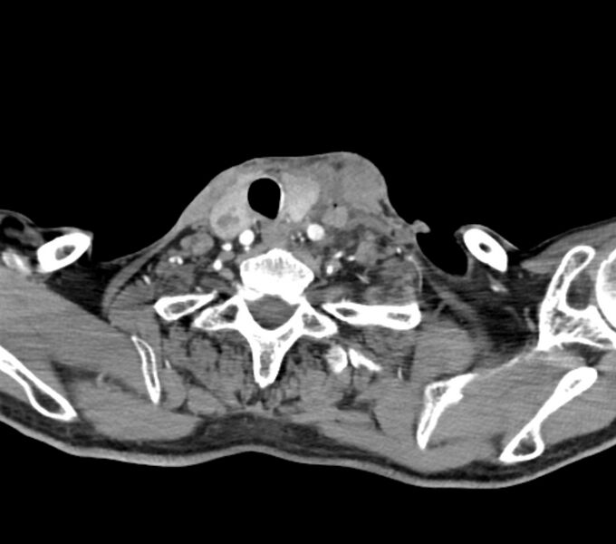 File:Carotid artery pseudoaneurysm (Radiopaedia 84030-99259 C 66).jpg