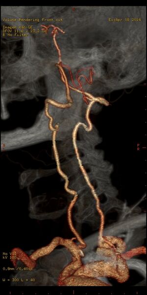 File:Carotid artery stenosis (Radiopaedia 28786-29086 B 6).jpg