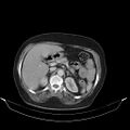 Carotid body tumor (Radiopaedia 21021-20948 A 57).jpg