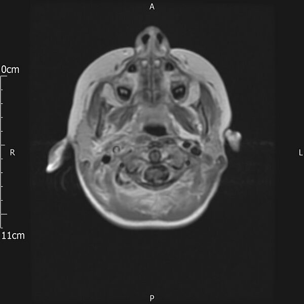 File:Cavernous sinus thrombosis (Radiopaedia 79414-92512 Axial T1 C+ 1).jpg