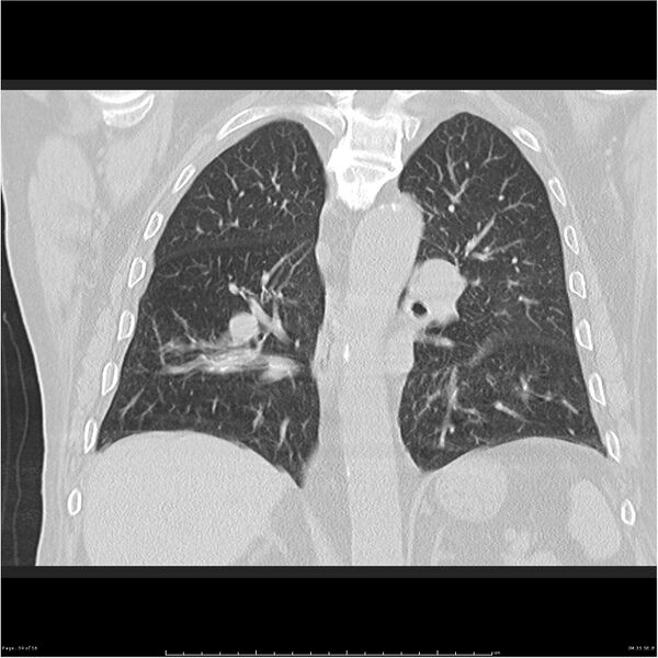 File:Cavitating left lower lobe lesion - squamous cell lung cancer (Radiopaedia 27749-28176 Coronal lung window 34).jpg