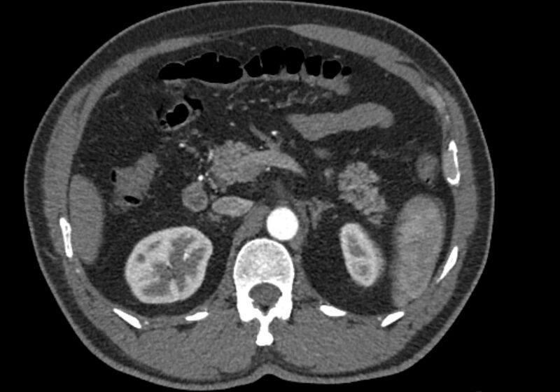 File:Celiac artery dissection (Radiopaedia 52194-58080 A 34).jpg