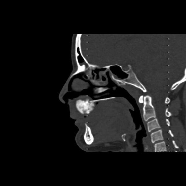 File:Cemento-ossifying fibroma (Radiopaedia 21243-21149 Sagittal bone window 6).jpg