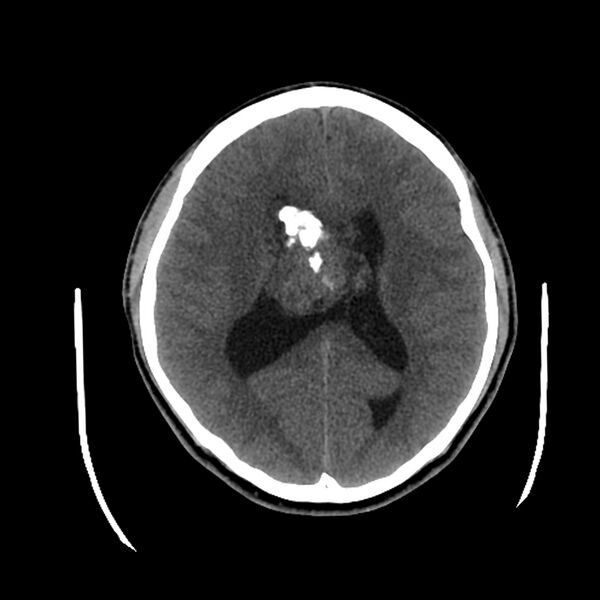 File:Central neurocytoma (Radiopaedia 79320-92379 Axial non-contrast 29).jpg
