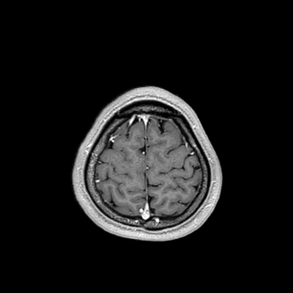 File:Central neurocytoma (Radiopaedia 79320-92380 Axial T1 C+ 204).jpg