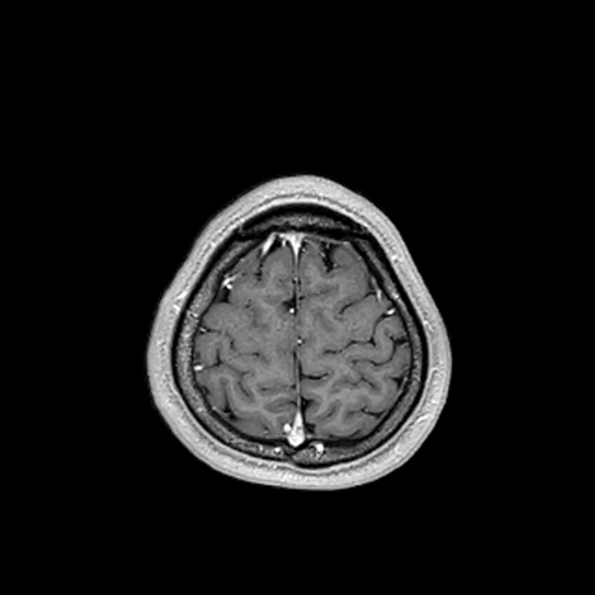 Central neurocytoma (Radiopaedia 79320-92380 Axial T1 C+ 204).jpg