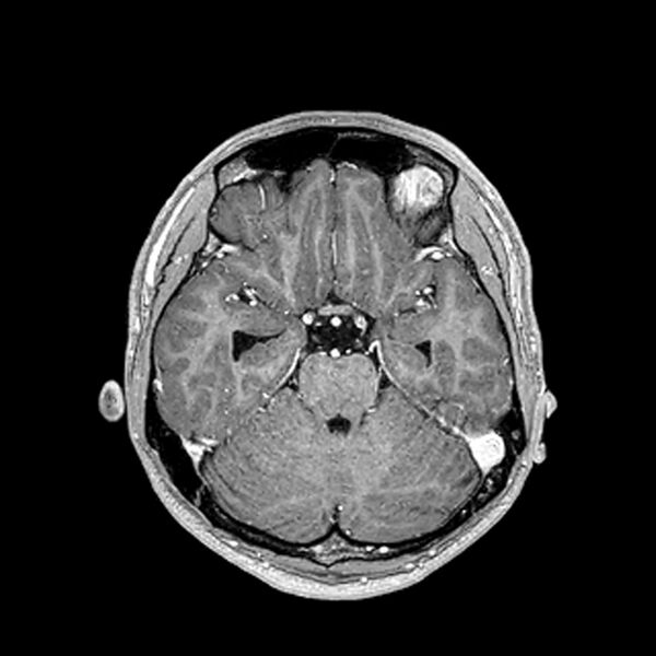 File:Central neurocytoma (Radiopaedia 79320-92380 Axial T1 C+ 94).jpg