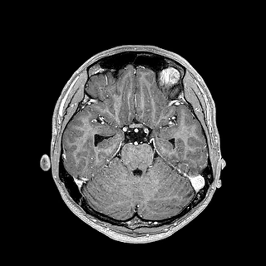Central neurocytoma (Radiopaedia 79320-92380 Axial T1 C+ 94).jpg