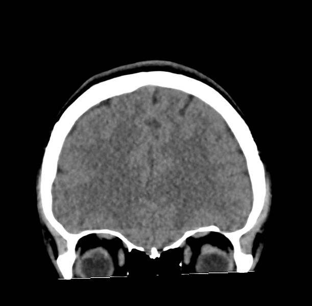 File:Cerebellar agenesis (Radiopaedia 30203-30817 Coronal non-contrast 1).jpg