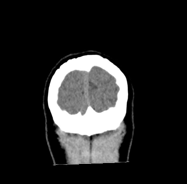 File:Cerebellar agenesis (Radiopaedia 30203-30817 Coronal non-contrast 49).jpg