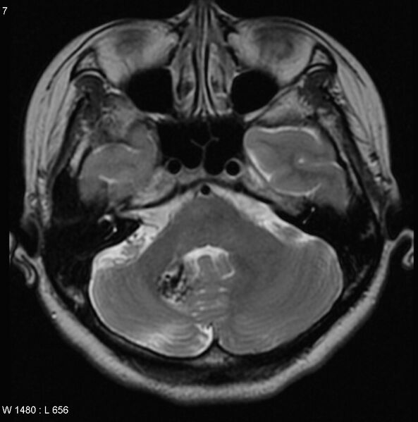File:Cerebellar arteriovenous malformation (Radiopaedia 5220-6988 Axial T2 3).jpg