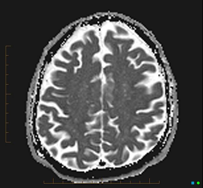 File:Cerebellar gangliocytoma (Radiopaedia 65377-74422 Axial ADC 29).jpg