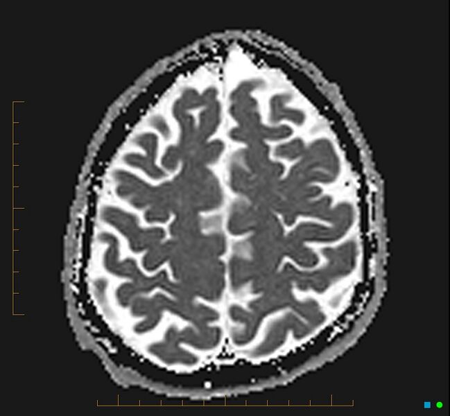 File:Cerebellar gangliocytoma (Radiopaedia 65377-74422 Axial ADC 31).jpg
