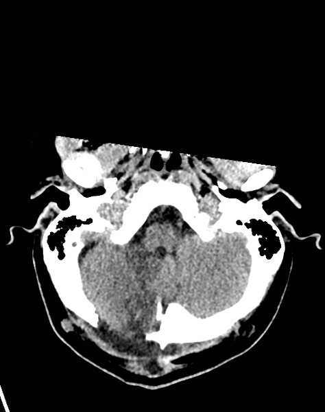 File:Cerebellar infarct due to vertebral artery dissection with posterior fossa decompression (Radiopaedia 82779-97033 Axial non-contrast 8).png