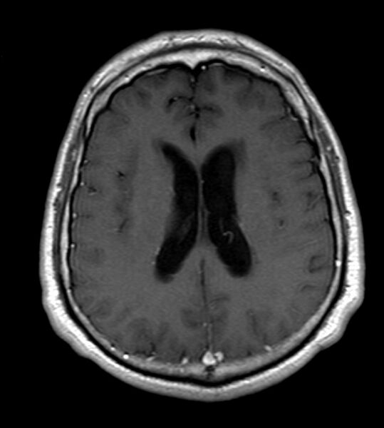 File:Cerebellopontine angle meningioma (Radiopaedia 24459-24764 Axial T1 C+ 16).jpg
