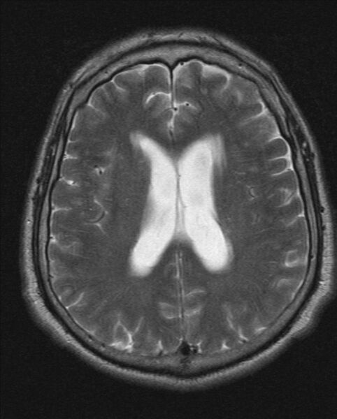 File:Cerebellopontine angle meningioma (Radiopaedia 24459-24764 Axial T2 15).jpg