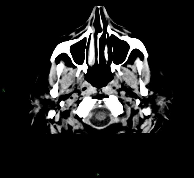 File:Cerebral amyloid angiopathy-associated lobar intracerebral hemorrhage (Radiopaedia 58376-65511 Axial non-contrast 53).jpg