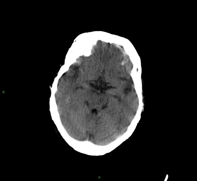 File:Cerebral amyloid angiopathy-associated lobar intracerebral hemorrhage (Radiopaedia 58377-65514 Axial non-contrast 32).jpg