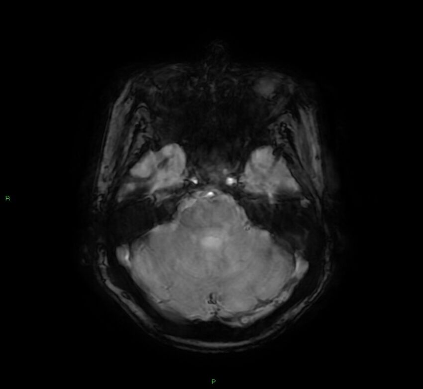 Cerebral amyloid angiopathy-associated lobar intracerebral hemorrhage (Radiopaedia 58378-65517 Axial SWI 20).jpg