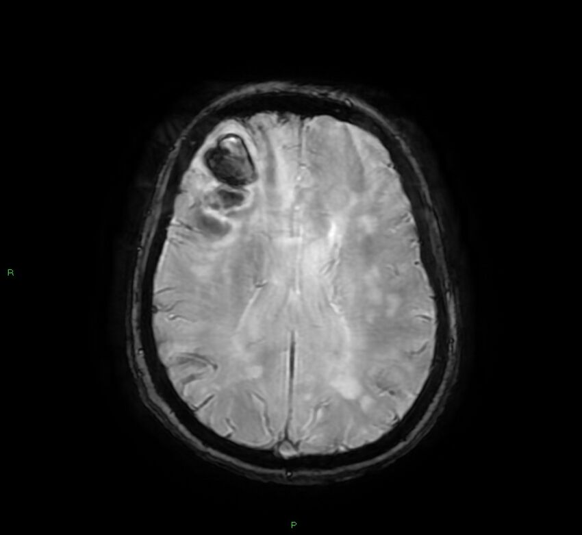 Cerebral amyloid angiopathy-associated lobar intracerebral hemorrhage (Radiopaedia 58378-65517 Axial SWI 46).jpg