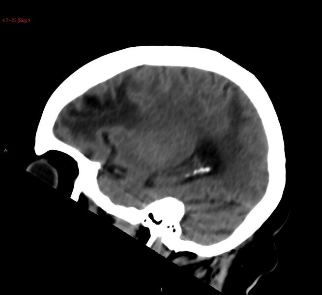 File:Cerebral amyloid angiopathy-associated lobar intracerebral hemorrhage (Radiopaedia 58378-65518 C 23).jpg