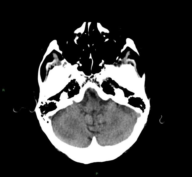 File:Cerebral amyloid angiopathy-associated lobar intracerebral hemorrhage (Radiopaedia 58530-65688 Axial non-contrast 40).jpg