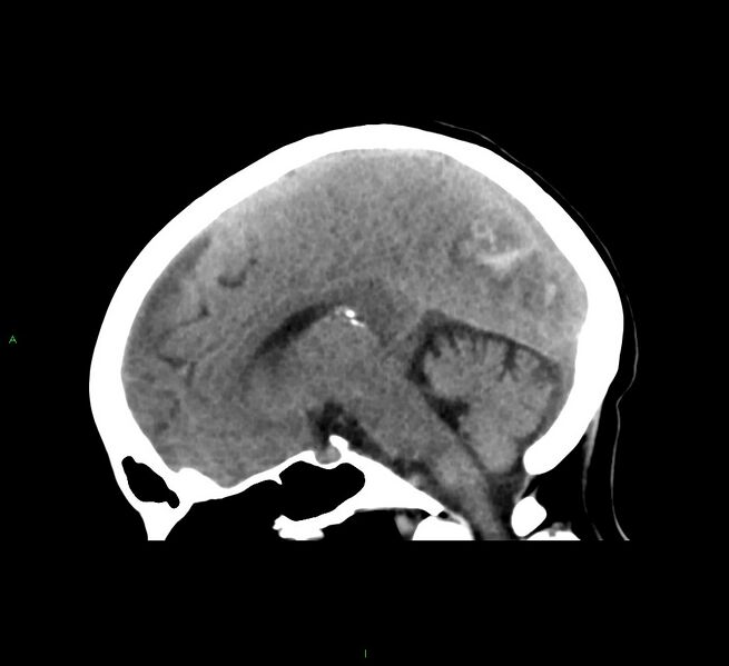 File:Cerebral amyloid angiopathy-associated lobar intracerebral hemorrhage (Radiopaedia 58563-65727 C 27).jpg