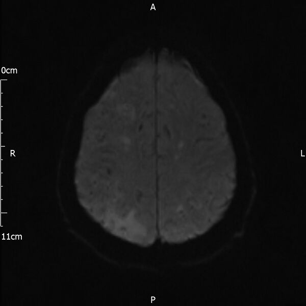 File:Cerebral amyloid angiopathy related inflammation (Radiopaedia 72772-83415 Axial DWI 41).jpg