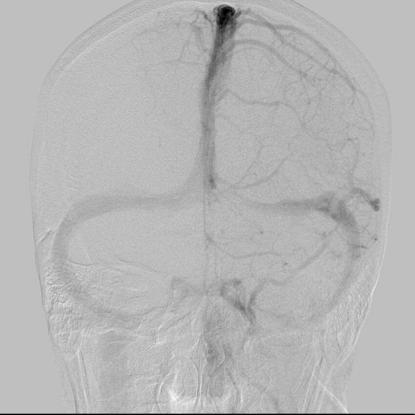 Cerebral aneurysm with rupture (Radiopaedia 29933-30458 LT CCA IC 22).jpg