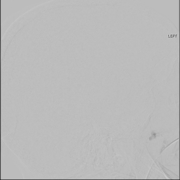 File:Cerebral arteriovenous malformation with lobar hemorrhage (Radiopaedia 44725-48513 LT CCA IC 29).png
