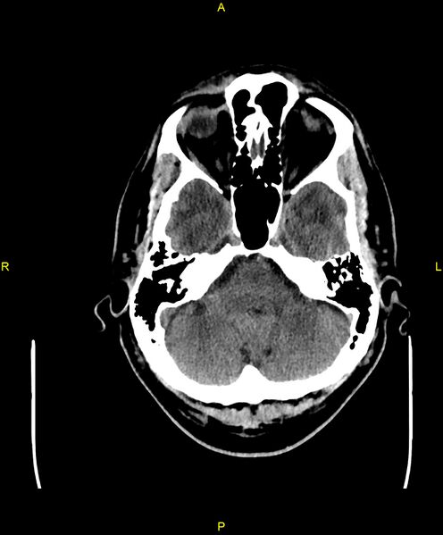 File:Cerebral autosomal dominant arteriopathy with subcortical infarcts and leukoencephalopathy (CADASIL) (Radiopaedia 86108-102051 Axial non-contrast 22).jpg