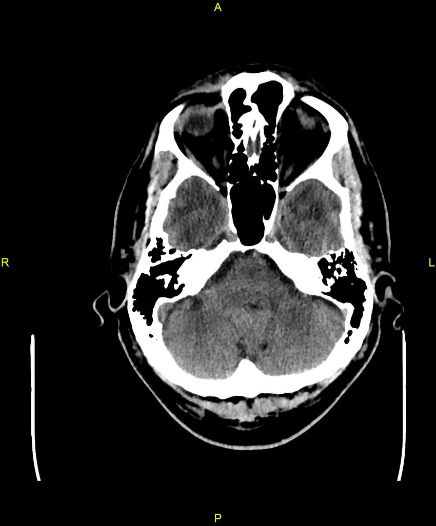 Cerebral autosomal dominant arteriopathy with subcortical infarcts and leukoencephalopathy (CADASIL) (Radiopaedia 86108-102051 Axial non-contrast 22).jpg