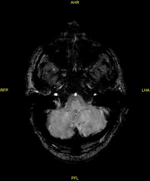 File:Cerebral autosomal dominant arteriopathy with subcortical infarcts and leukoencephalopathy (CADASIL) (Radiopaedia 86108-102054 Axial SWI 21).jpg