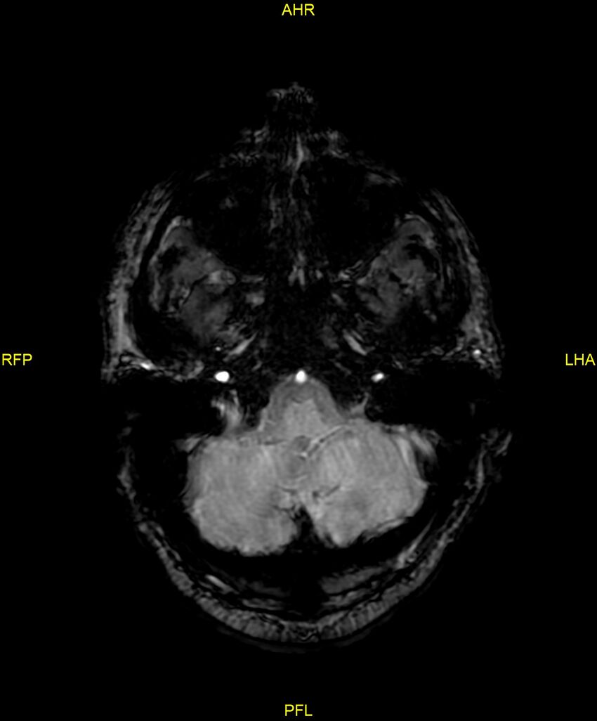 Cerebral autosomal dominant arteriopathy with subcortical infarcts and leukoencephalopathy (CADASIL) (Radiopaedia 86108-102054 Axial SWI 21).jpg
