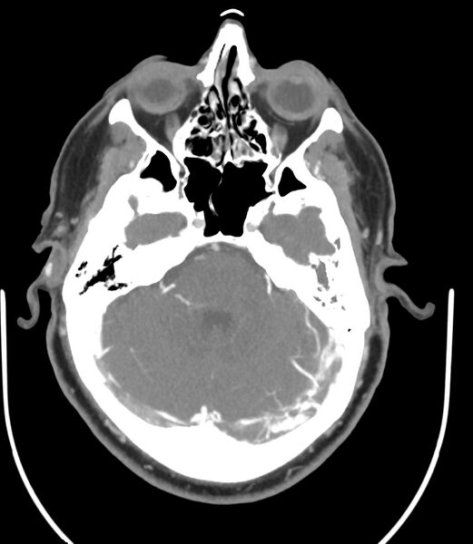 File:Cerebral dural venous sinus thrombosis (Radiopaedia 86514-102576 A 39).jpg