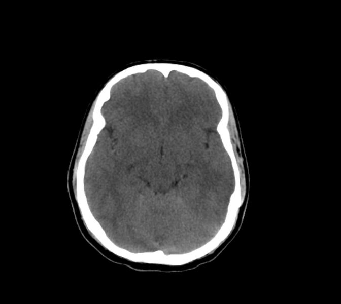 File:Cerebral fat embolism (Radiopaedia 37510-39362 Axial non-contrast 15).jpg
