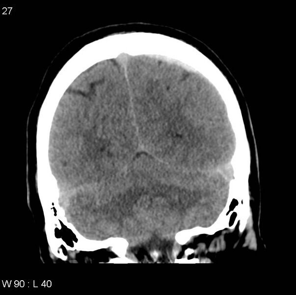 File:Cerebral hemorrhagic contusion with subdural and subarachnoid hemorrhage (Radiopaedia 10680-11146 Coronal non-contrast 14).jpg