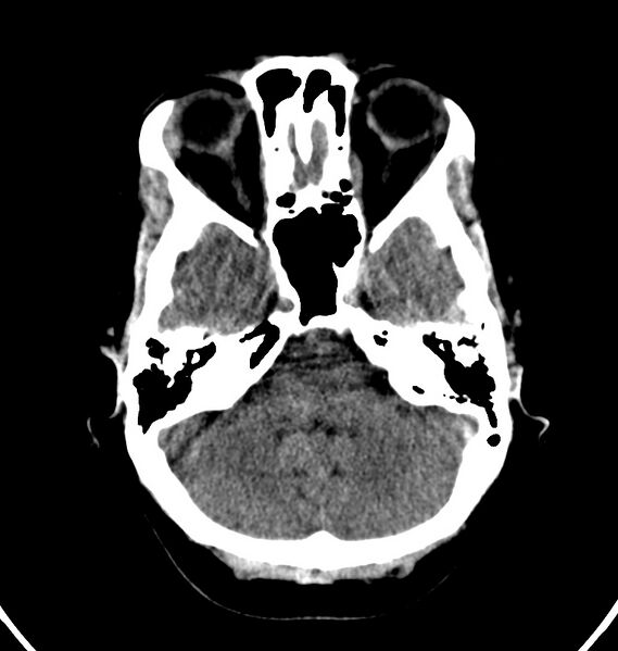 File:Cerebral venous thrombosis - CT only (Radiopaedia 41031-43778 Axial non-contrast 67).jpg