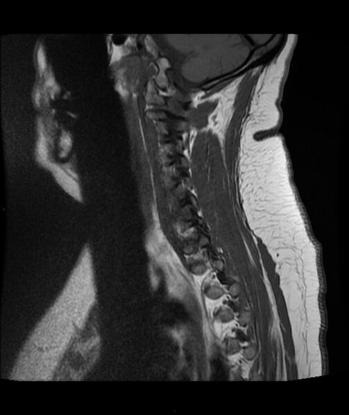 File:Cervical disc prolapse (Radiopaedia 80258-93598 Sagittal T1 12).jpg