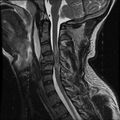 Cervical flexion teardrop fracture with cord hemorrhage (Radiopaedia 32497-33455 Sagittal T2 10).jpg