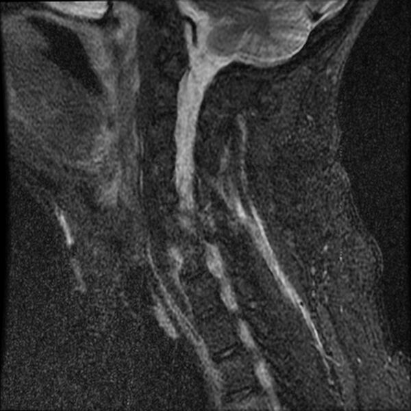 File:Cervical fracture and dislocation with locked facet (Radiopaedia 31837-32781 Sagittal STIR 12).jpg