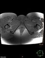 Cesarian scar endometriosis (Radiopaedia 68495-78066 Axial T1 fat sat 27).jpg