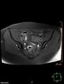 Cesarian scar endometriosis (Radiopaedia 68495-78066 Axial T1 fat sat 8).jpg