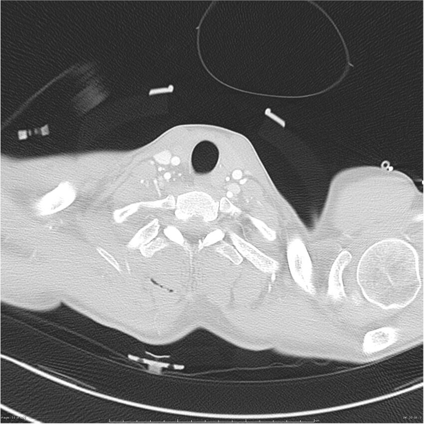 Chest and abdomen multi-trauma (Radiopaedia 26294-26425 lung window 10).jpg