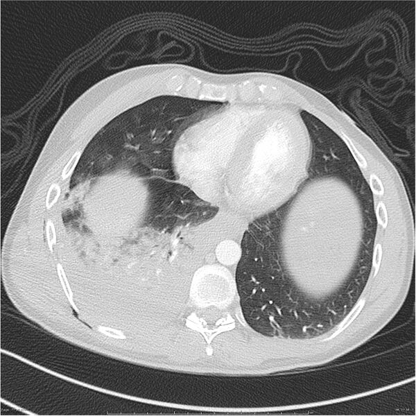 File:Chest and abdomen multi-trauma (Radiopaedia 26294-26425 lung window 77).jpg