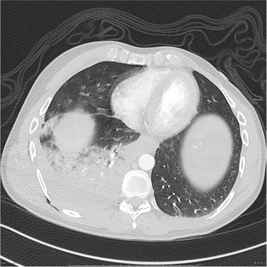 Chest and abdomen multi-trauma (Radiopaedia 26294-26425 lung window 77).jpg