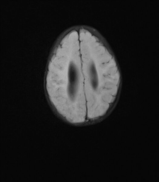 File:Chiari III malformation with occipital encephalocele (Radiopaedia 79446-92559 Axial FLAIR 20).jpg