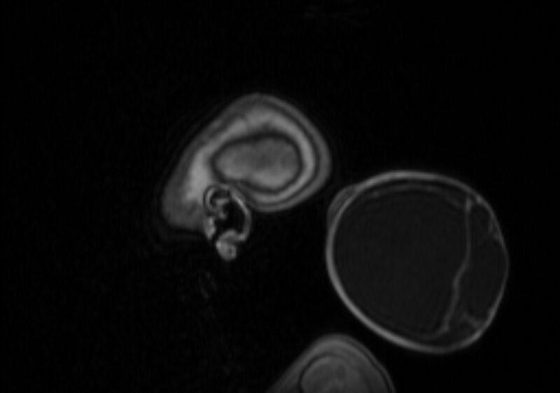 File:Chiari III malformation with occipital encephalocele (Radiopaedia 79446-92559 Sagittal T1 C+ mpr 12).jpg