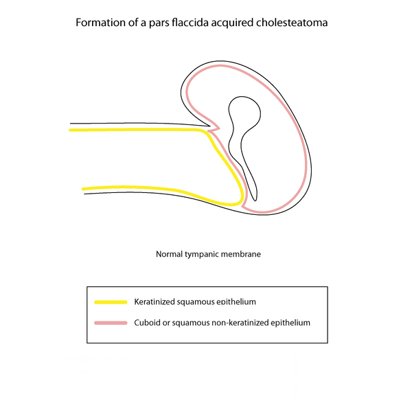 File:Cholesteatoma formation (illustrations) (Radiopaedia 9672-10297 Normal 1).png