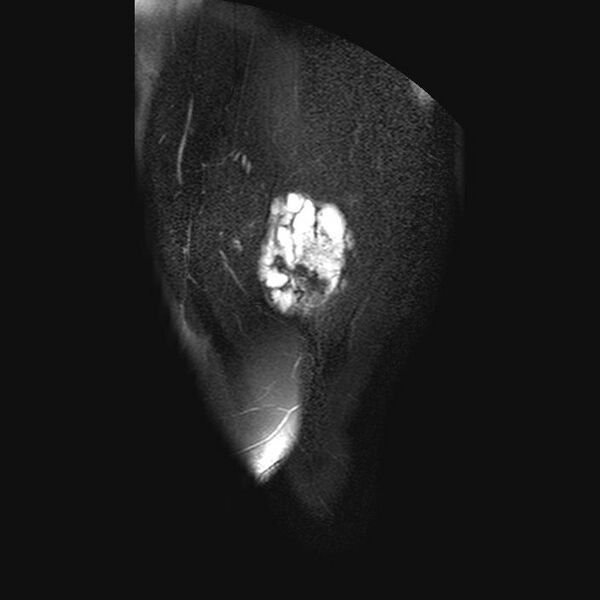 File:Chondrosarcoma arising from exostosis (Radiopaedia 59996-67686 C 2).jpg